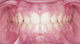 Overbite Front After - Your Treatment