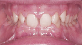 Overbite Front Before - Your Treatment