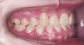 Underbite After - Your Treatment