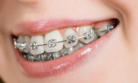 braces orthodontist near me vestal 2 1 - Your Treatment
